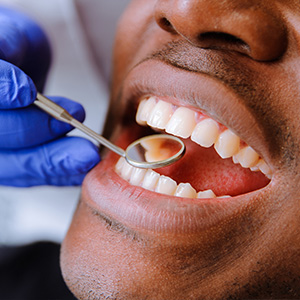An individual receiving dental care, with a dental instrument in their mouth and a toothbrush in the process of cleaning their teeth.