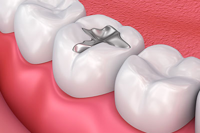 The image shows a close-up of a human tooth with an implant or dental crown, set against the backdrop of a pink gum and part of a dental arch.