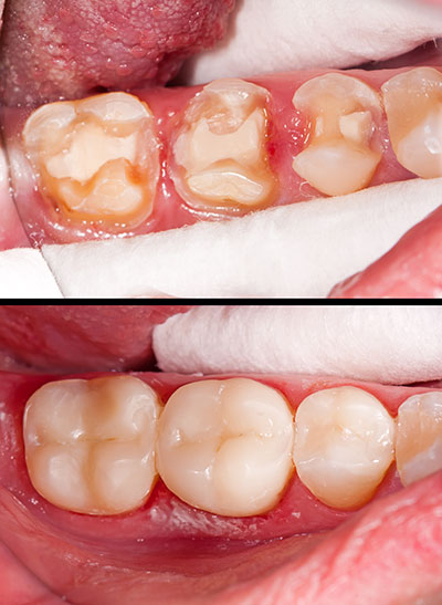 The image shows a close-up of a person s mouth with teeth that appear to be in need of dental care, specifically showing signs of decay and discoloration.