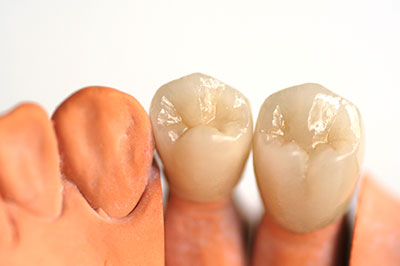 The image shows a set of dental implants and crowns displayed against a white background.