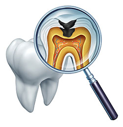 An illustration of a magnifying glass with an X-ray image inside, showing a tooth with a visible cavity and surrounding tissues, highlighting dental health concerns.