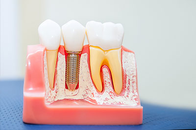 An image of a dental model with artificial teeth and gums, showcasing the process of tooth implantation.