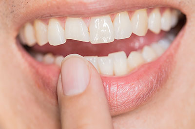 An image of a person s hand holding a small mirror to their mouth, revealing a smile with teeth that appear to be in the process of being straightened or aligned.