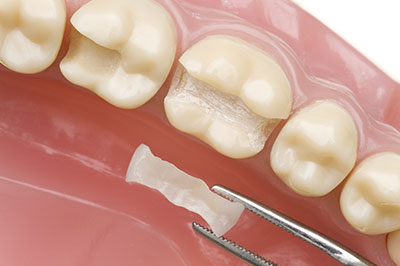 The image shows a close-up of a dental implant being inserted into a prepared tooth socket, with a small amount of bone graft material present.