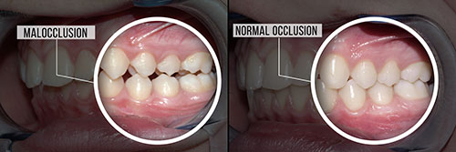 Before and after dental implant comparison with a focus on the transformation of the oral cavity, highlighting the change in tooth structure.