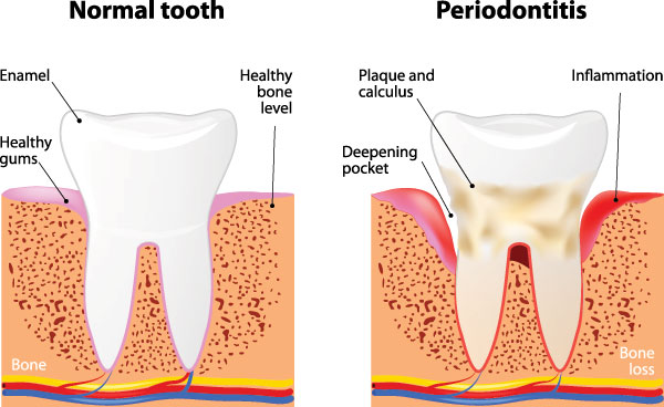 The image is a medical illustration showing the stages of tooth decay from normal to severe, with annotations indicating the progression of gum disease and bone loss.