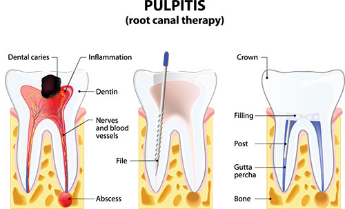 The image is a detailed medical illustration showing the structure of a human tooth and its root canal system, with labels indicating various parts such as dental caries, inflammation, crown, filling, vessels, and gums.