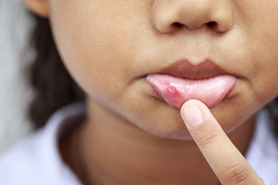 An image of a child with a finger on their lips, showing a red mark or blemish.