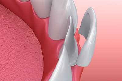 The image shows a close-up of a dental implant with multiple screws and a pink gum line, set against a red background.