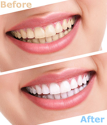 The image shows a split-screen comparison of teeth whitening results. On the left, there is a close-up of a person s teeth before the treatment, and on the right, the same teeth after the treatment, appearing significantly whiter.